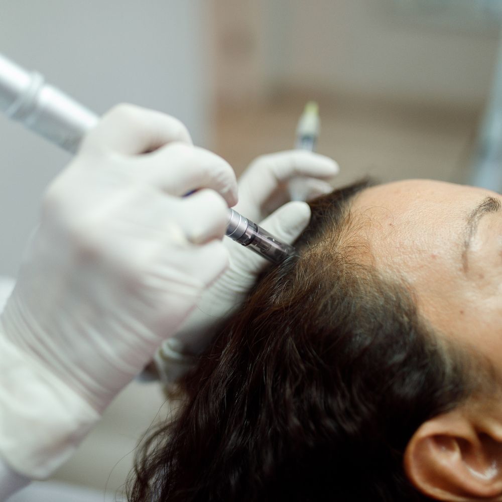 Microneedling Capilar